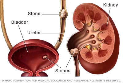 How to eliminate kidney stones naturally and easily